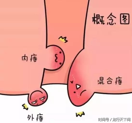 痔疮包括内痔,外痔,混合痔,是肛门直肠底部及肛门黏膜的静脉丛发生