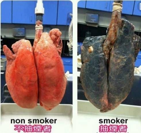 戒烟后,人的肺还能恢复正常吗?