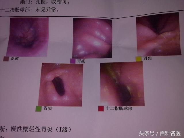 3.胃息肉患者,腺瘤型或绒毛型息肉癌变率高达15%~40%.