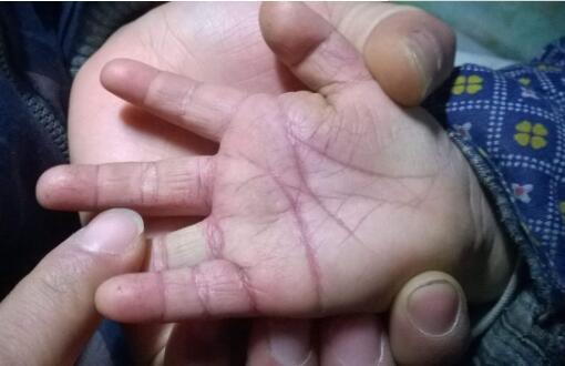 小孩手开裂口子怎么办 儿童手指肚干裂口子怎么办