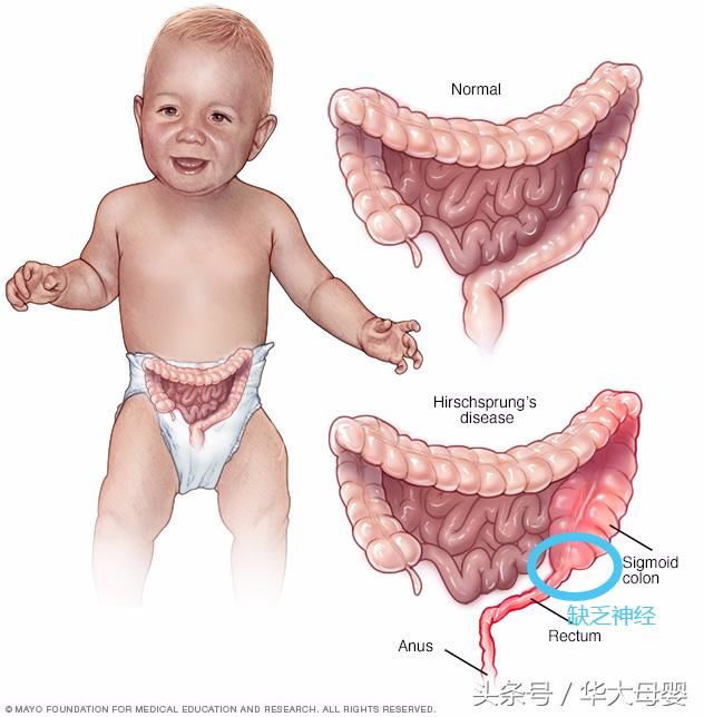 后果就是,孩子肠梗阻,排便不畅,拒食,呕吐,腹大如鼓,容易合并小肠结