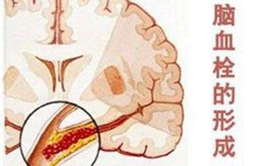 发生于颅内后循环血管,脑血栓也有5个前兆: 1,视物模 ..