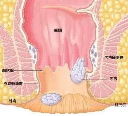 实际上,直肠癌早期症状与痔疮这两种病是有区别的. 首先,便血不同.