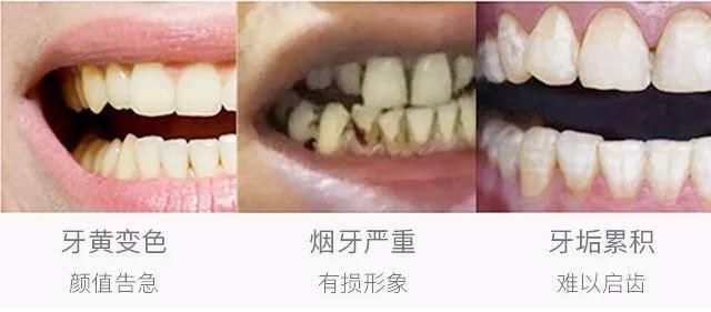 如果不及时清理,长期累积还会形成牙结石,引发牙周炎,甚至会造成牙齿