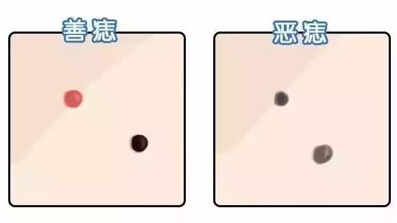 痣相看运势,脸上长痣看命运,看看你的痣是好是坏!