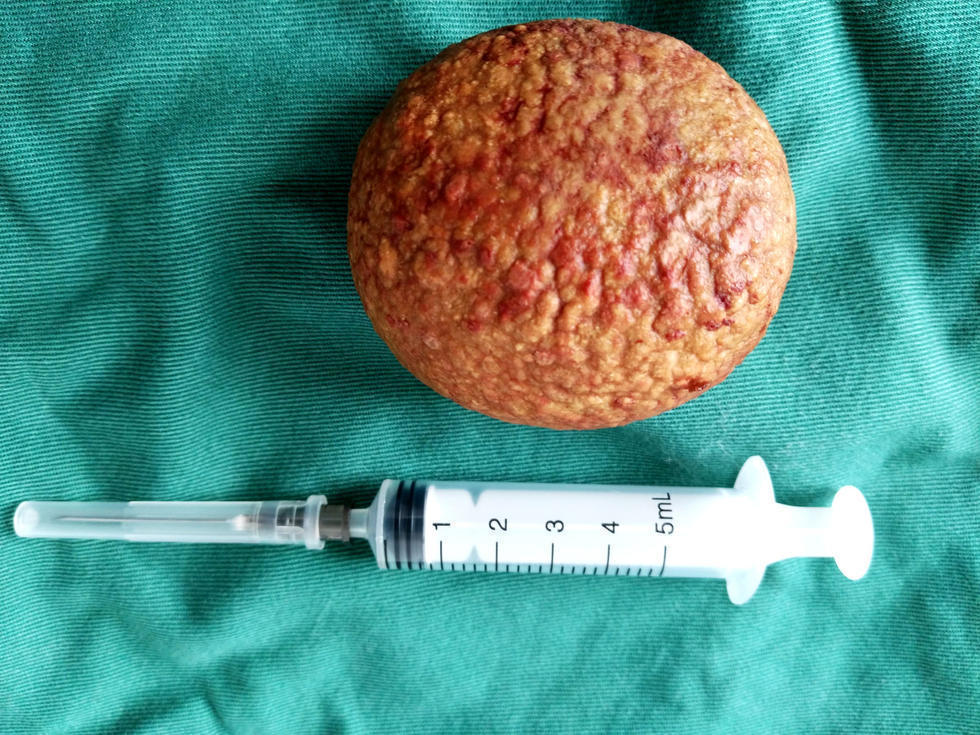 男子膀胱内取出鸭蛋大结石 重量超过1斤