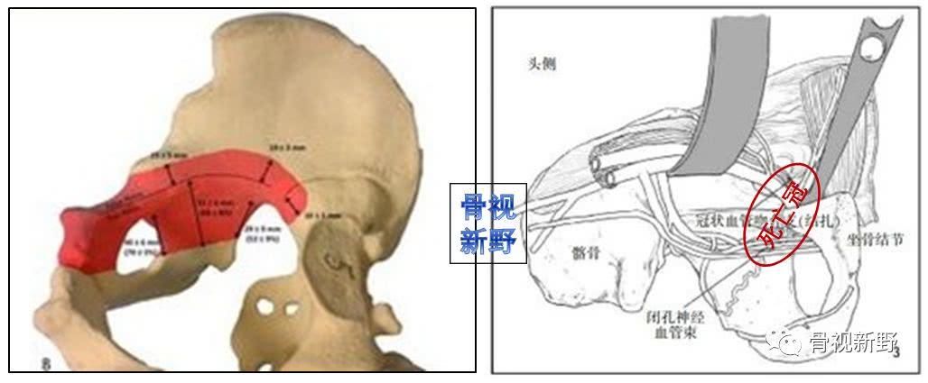 改良stoppa入路髋臼前壁,四边体骨折的orif