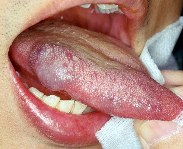 这3种口腔溃疡是舌癌的信号!花2分钟做一件事可阻断