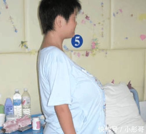 13岁女孩胸部太大,受尽同学嘲笑,手术过后,让她重获新生