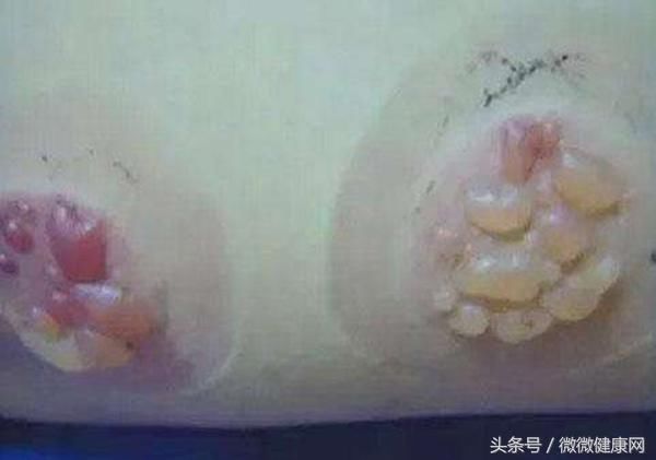 妙龄起拔罐溃烂背部导致,20岁水泡女生再也不遇害教室高一少女图片
