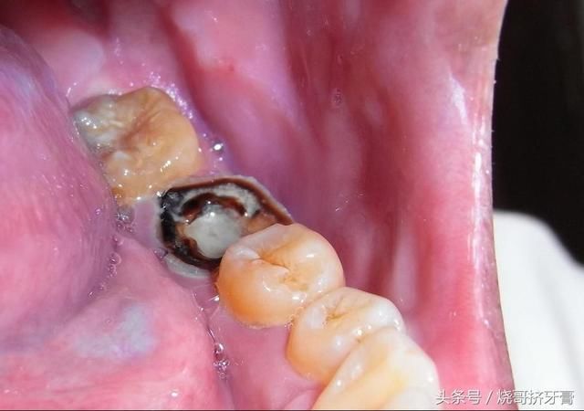 牙齿被蛀掉了一半!怎么判断牙髓坏死?