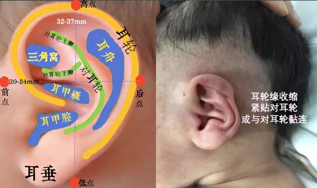 一,胚胎发育期间的"故障" 导致耳廓软骨发育中产生异常折叠; 二,耳廓