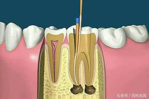 抽牙神经真的那么恐怖吗?麻药根本无法抑制疼痛?
