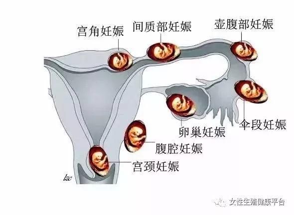 女人小肚子突然剧烈疼痛,警惕这些病!(收藏)
