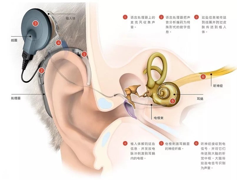 海安惠耳:高考学子利用助听器,人工耳蜗作弊?真相到底