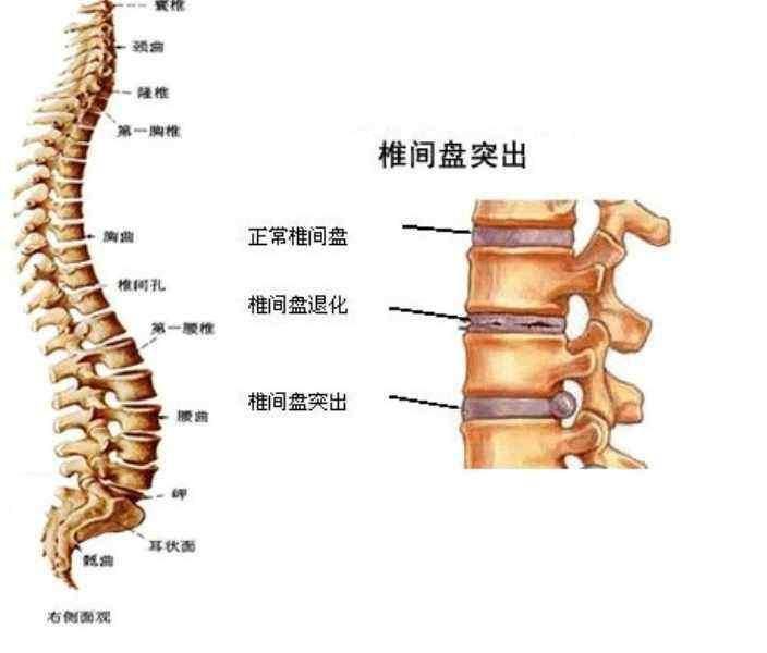 腰间盘突出怕它干嘛!民间传统秘方干掉它.