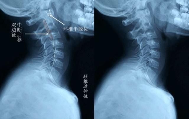 经过ct检查,医生表示男童的颈椎变成一条直线,生理弧度曲直了,正常