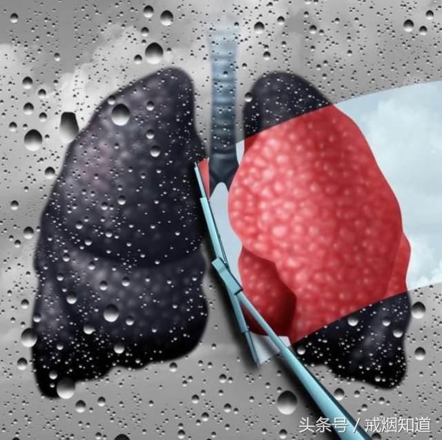吸烟者们,想让肺部好受一点吗?请记住这5件事