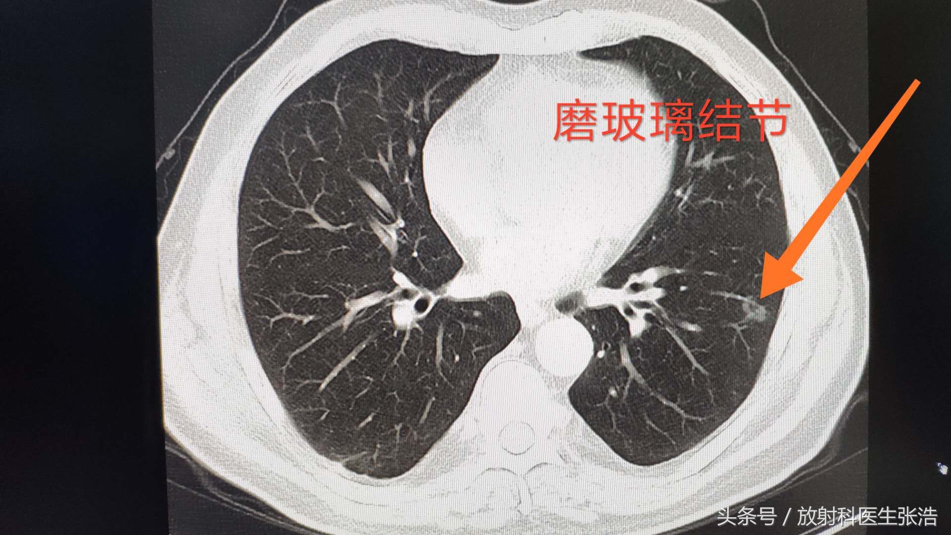 肺部什么样地小结节是早期肺癌,对比良性小结节图
