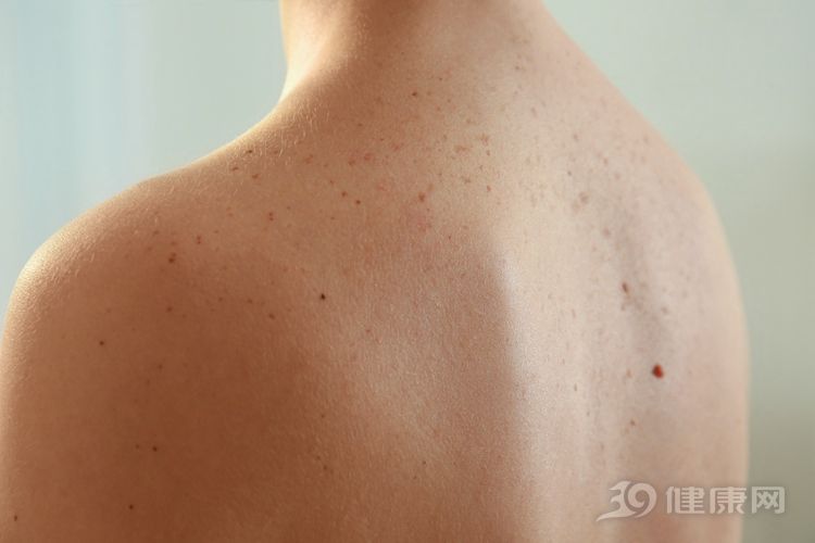 肝硬化早期症状四,蜘蛛痣的出现