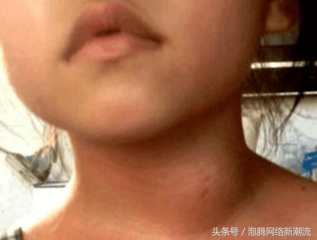 10岁男孩脖子鼓起一块,因家长的忽视而导致患癌