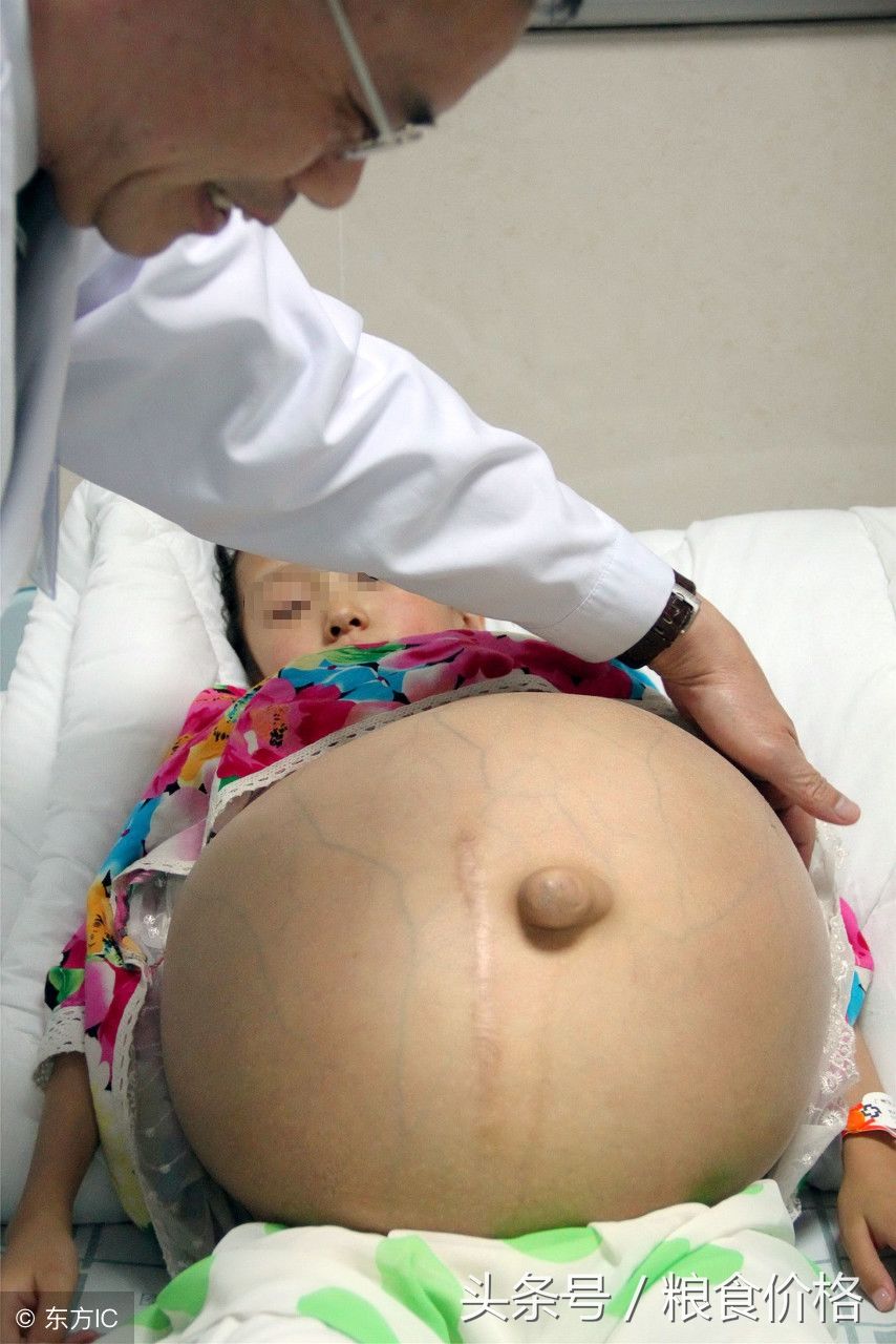 11岁的女孩意外"怀孕",28斤的大肚子让父母以泪洗面