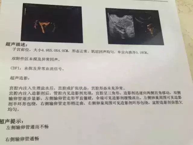 子宫输卵管4d造影检查