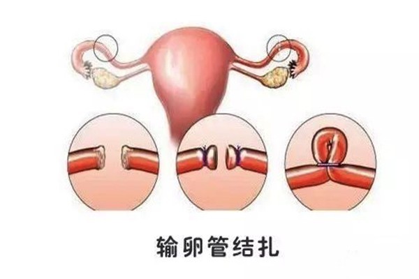 输卵管复通手术的过程,原来是这样的