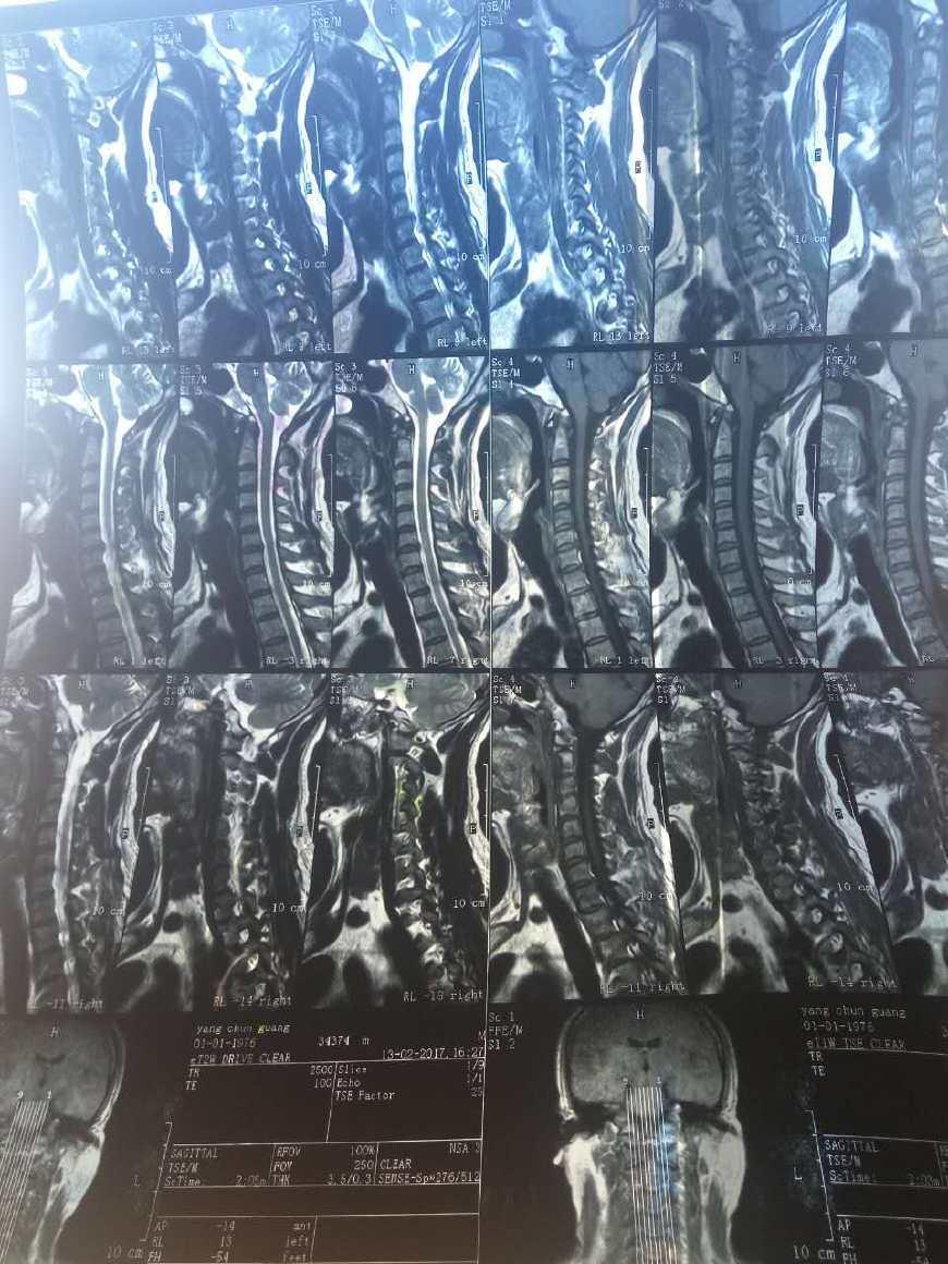 椎动脉?颈椎病有那些类型?颈椎病临床表现?全在这里了