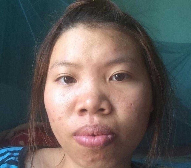 22岁的越南女孩艾米因为长得丑,一直都没人喜欢.