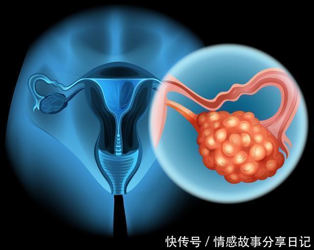 75%的恶性卵巢瘤会有此症状,良性卵巢瘤有15%左右会出现这一腹部包