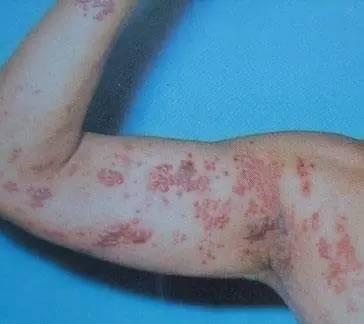 红斑狼疮是一种常见疾病,给很多患者带来困扰,如何早期发现红斑狼疮