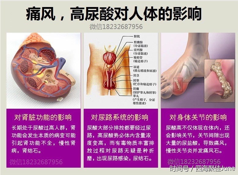 张麻麻:痛风发作时,有些什么办法可以好过一点?