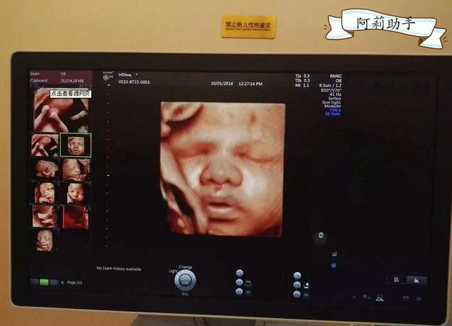 从一张四维彩超图,如何轻松辨别胎儿性别?