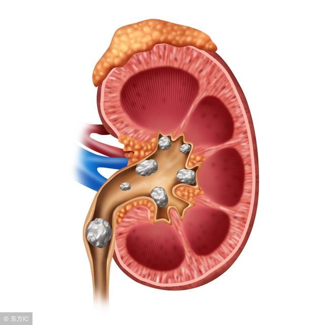 肾结石的分类,肾结石要根据分类对号入座