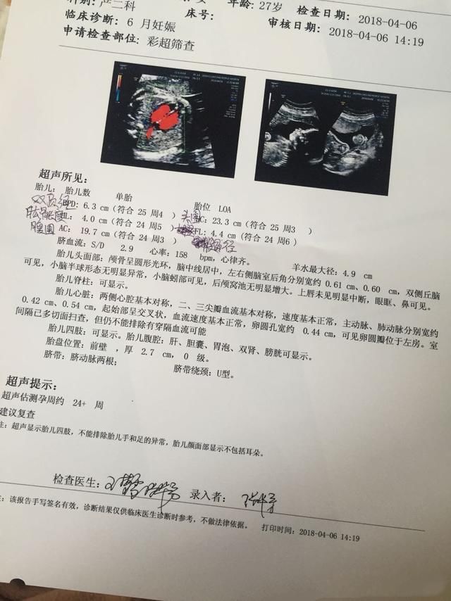孕24 4四维顺利通过 确定男宝 附症状 接儿子的快来