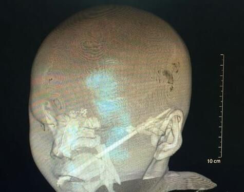 筷子等异物成幼童致命凶器 家长应时刻警醒