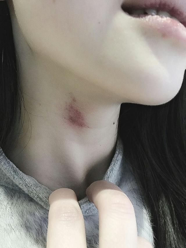 吻痕有一个文艺而清新脱俗的名字叫种草莓,青年男女们在热恋的时候