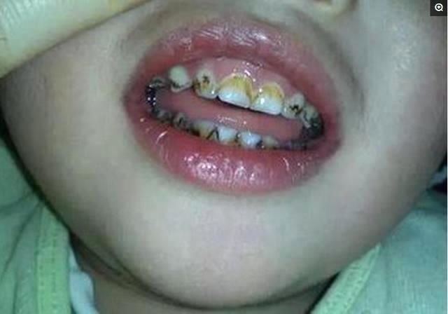 6岁孩子一直很少吃糖,可是牙齿全坏了,医生骂家长太无