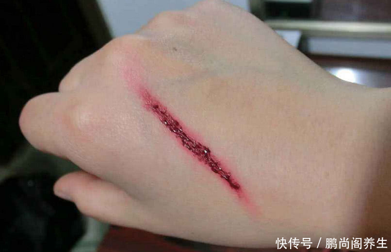 4,伤口愈合快 如果有两个人的手同时割破了皮,你会发现有的人伤口