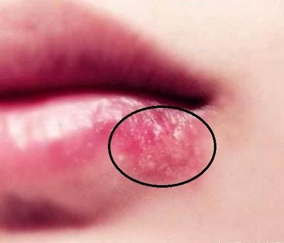 感染单纯性疱疹:这种烂嘴角的体现是在嘴角处长出了水泡,往往会感到