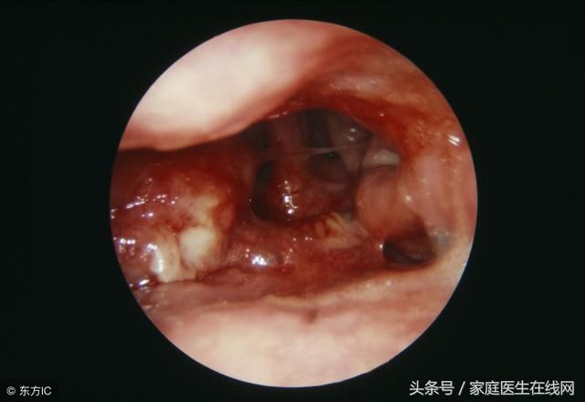 鼻咽癌和鼻咽炎到底有什么区别?从这3个方面来区分