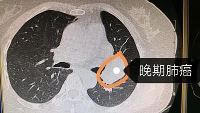 什么样的肺小结节可能是肺癌?医生用五张ct告诉你!