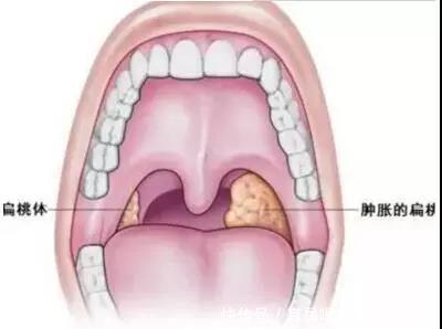 扁桃体窝:口咽外侧壁在腭咽弓和腭舌弓之间的三角形凹陷.