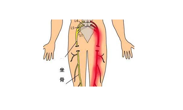 屁股疼怎么回事