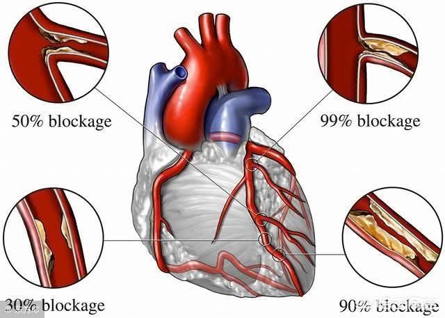 心脏有三个主血管,堵了一两个能维持心脏正常运转吗?