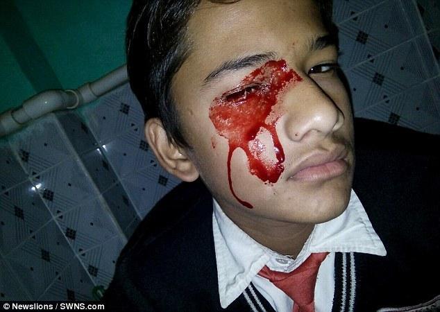 13岁少年眼耳鼻口到处流血 全印度医生无法确诊