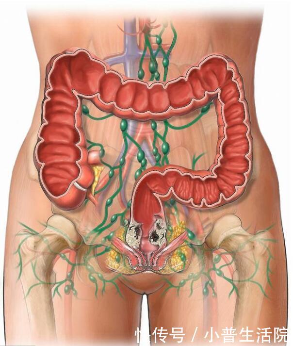 肛门痛,是得了痔疮吗?别被"十人九痔"的说法忽悠了
