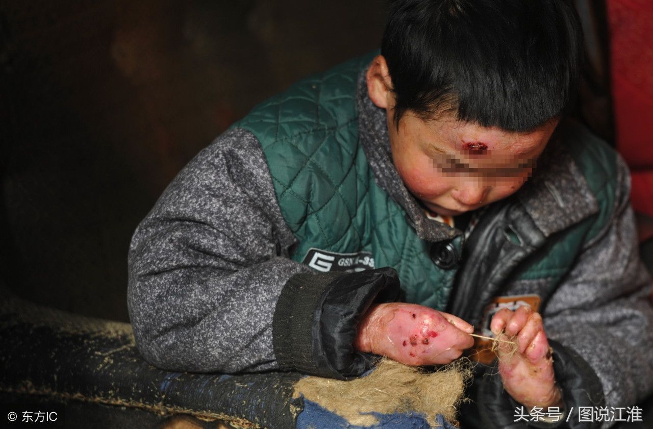 皮肤溃烂,8岁男孩2岁时就被确诊无法医治,细心爸妈用针管吸水疱