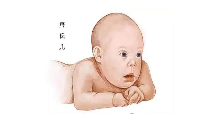唐氏患儿,说来就来,这6类孕妈很容易生下,越早了解越好